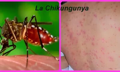 A Sombra do Aedes aegypti Primeira Morte por Chikungunya em Campinas e as Li es Que N o Podemos Ignorar