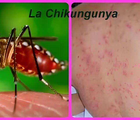 A Sombra do Aedes aegypti: Primeira Morte por Chikungunya em Campinas e as Lições Que Não Podemos Ignorar 2 A Sombra do Aedes aegypti Primeira Morte por Chikungunya em Campinas e as Li es Que N o Podemos Ignorar