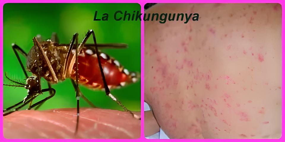 A Sombra do Aedes aegypti: Primeira Morte por Chikungunya em Campinas e as Lições Que Não Podemos Ignorar 1 A Sombra do Aedes aegypti Primeira Morte por Chikungunya em Campinas e as Li es Que N o Podemos Ignorar