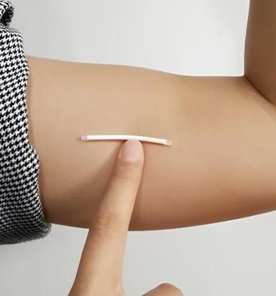 Implante Contraceptivo no SUS: Uma Revolução Silenciosa na Saúde da Mulher Brasileira 2 Implante Contraceptivo no SUS Uma Revolu o Silenciosa na Sa de da Mulher Brasileira